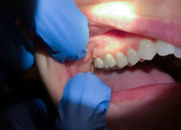 Best Emergency Dental Care for Abscessed Tooth in Henderson, NC